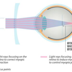 Rocky Myopia Control 360 Độ